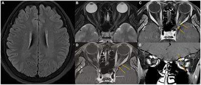 Case report: Tolosa-Hunt syndrome—expanding the neuromyelitis optica spectrum disorder phenotype?